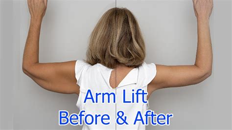 Arm Lift Las Vegas .